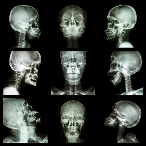 脑X光片图图片