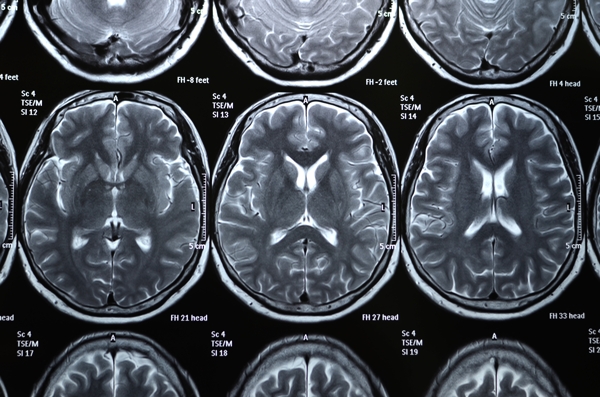 人体脑部X光片图片