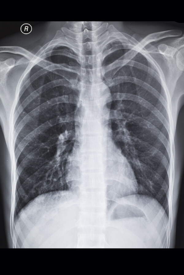 胸部X光片图片图片
