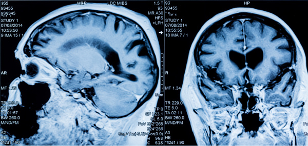 头颅CT照片图片