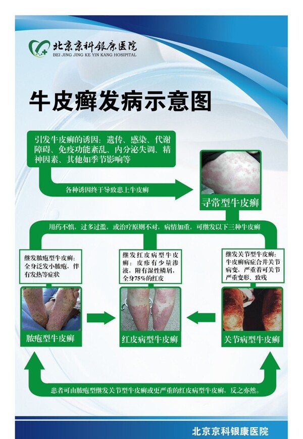 牛皮癬發(fā)病示意圖圖片