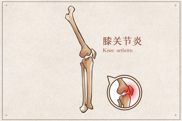 膝关节炎骨骼宣传展板素材