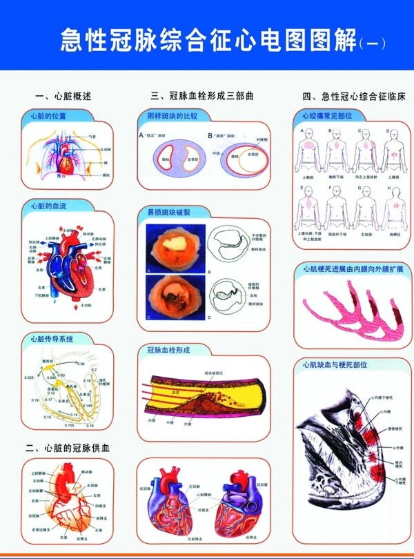 急性冠脉综合征心电图图解